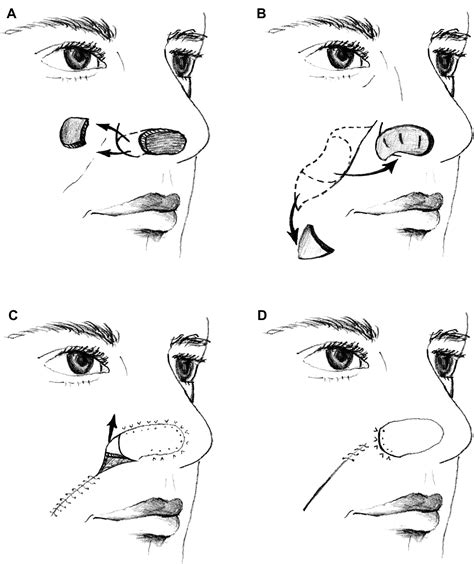Melolabial Flaps For Nasal Reconstruction Facial Plastic Surgery Clinics