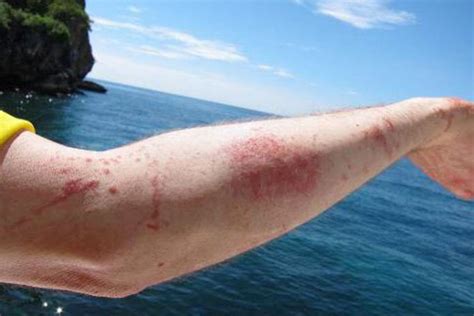 How To Treat And Prevent Jellyfish Stings