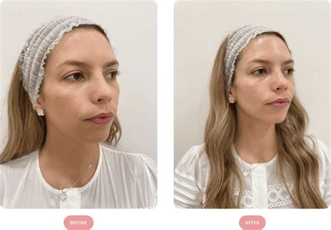 Hydrafacial Led Light Therapy Skin Plus Beauty