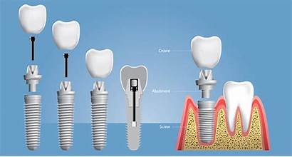 Dental Implants Teeth Need Know Types Practice