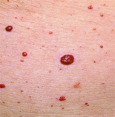 Thrombosed Cherry Angioma Pathology Of Cherry Angioma Senile Angioma