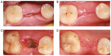 Healing Of Local Gingival Tissue Following Tooth Extraction Gingival