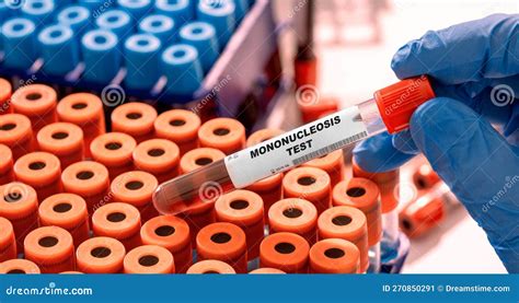 Mononucleosis Test Tube With Blood Sample In Infection Lab Stock Image