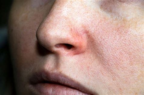 Dry Skin Around The Nose Getting You Down Heres How To Fix It Luxebc