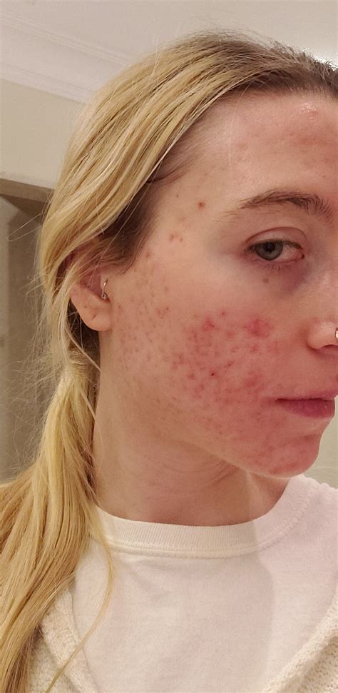 9 Month Accutane Transformation Before And After Photos — Crystal Clear