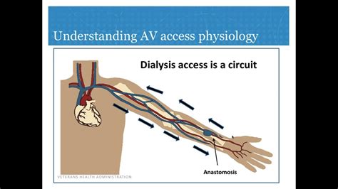 Dialysis Av Access And Cardiac Function Youtube