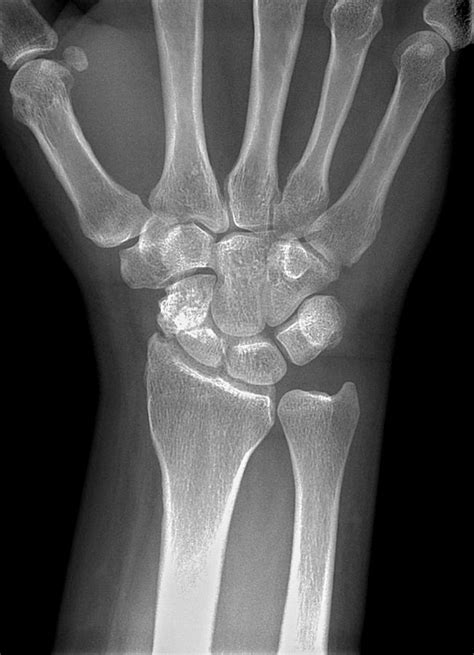 Fractured Wrist X Ray Photograph By Du Cane Medical
