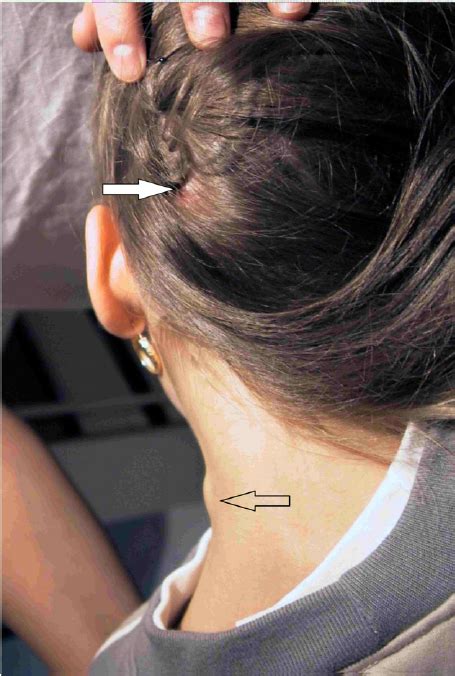 The Most Important Symptoms Of Tibola Eschar In The Scalp White