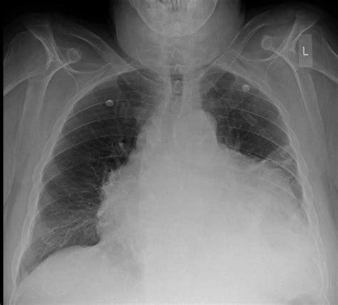 Cardiac Tamponade Cardio Guide