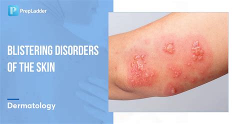 Blistering Disorders Of The Skin Neet Pg Dermatology