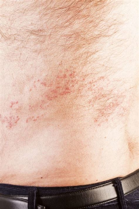 Shingles Symptoms Causes Rash Treatment In Australia