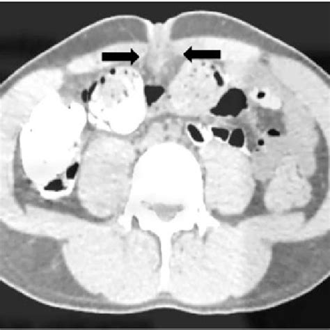 Abdominopelvic Ct Scan Shows A 25 · 25 Midline Cystic Mass Arrows