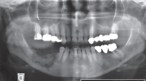Osteolytic Lesion In The Lower Jaw Of Patient Treated W Open I