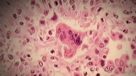 Health Officials Warn Of Possible Measles Exposure At Oakland