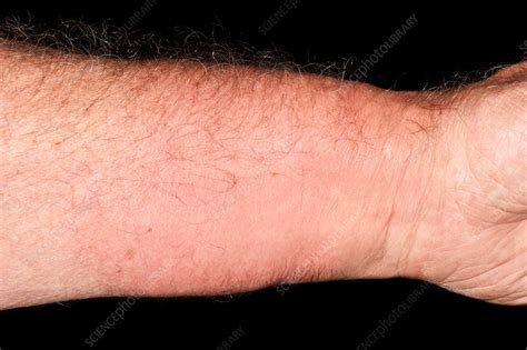 Wasp Sting Reaction Stock Image C0370855 Science Photo Library