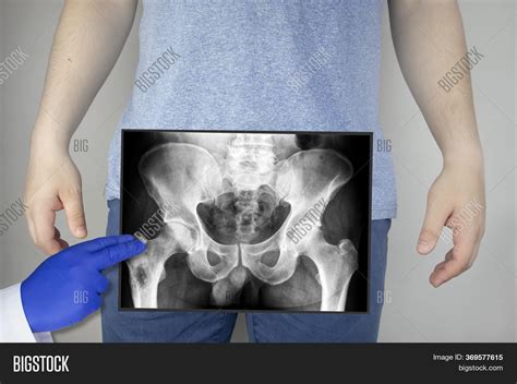 X Ray Pelvic Bones Man Image And Photo Free Trial Bigstock