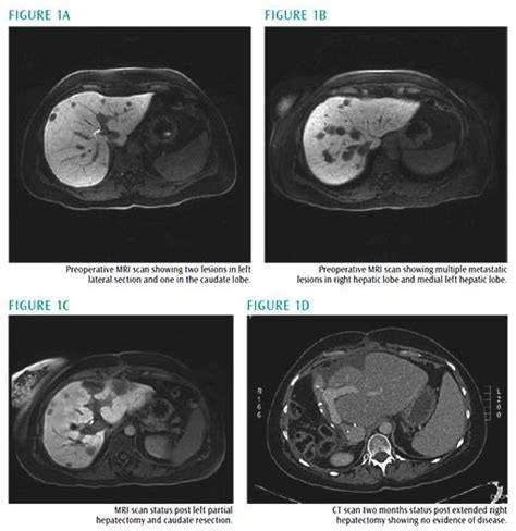 Colorectal Cancer Metastatic Towards The Liver Making The Unresectable