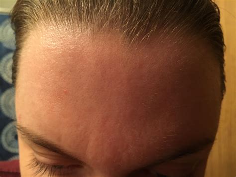 Skin Concerns My Forehead Is Filled With Tiny Craters How Can I