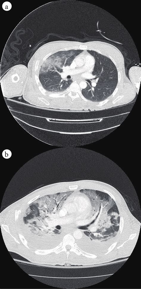 A Admission Ct Chest Showing Patchy Airspace Opacities In The Right