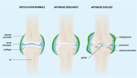 Larthrose Au Genou Ou Gonarthrose Bouge Tes Genoux