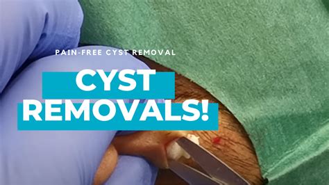 Watch Face Cyst Removal Completed In London Dr Khaled Sadek