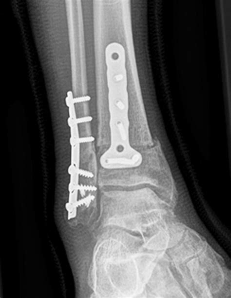 Joint Preserving Options For Eccentric Ankle Osteoarthritis Opnews