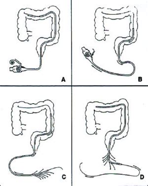 Colon Manometry Common Questions Iffgd