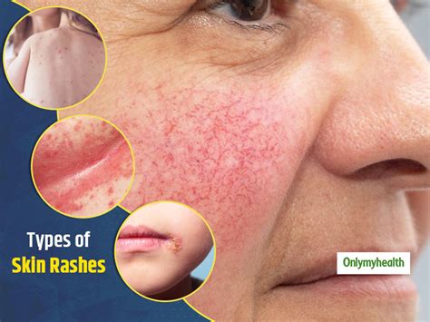 A Dermatologists Guide To 7 Types Of Skin Rashes