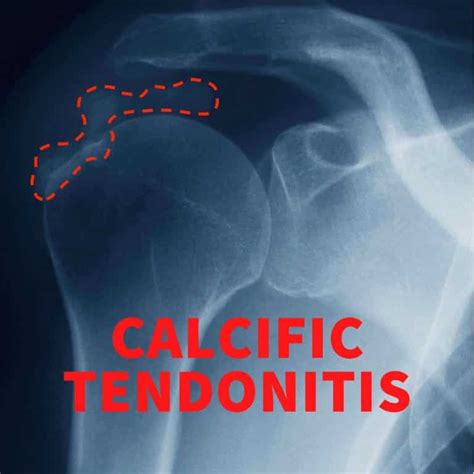 What Causes Calcific Tendinitis Symptoms Complications And Treatment
