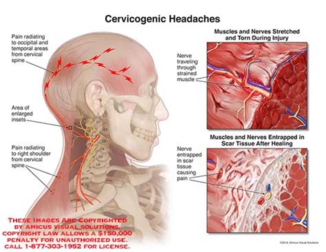 Who Cervicogenic Headache Cluster Headaches