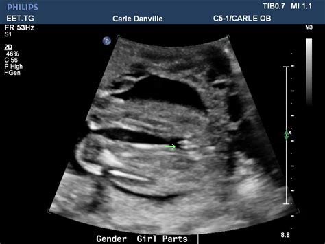 20 Week Ultrasound Girl Turtle Opinion Plz Babycenter