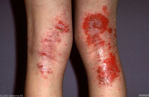 Medical Pictures Info Atopic Dermatitis
