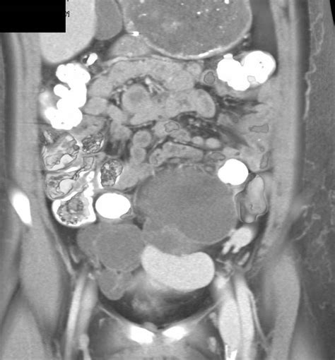 Ovarian Cancer With Splenic Implants Obgyn Case Studies Ctisus Ct