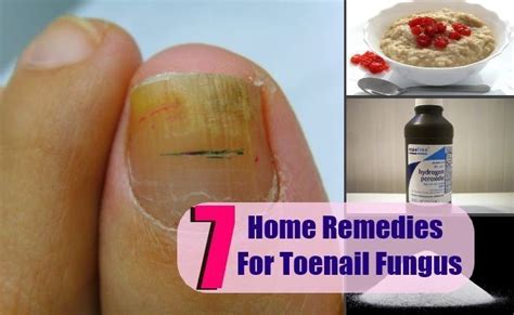 7 Home Remedies For Toenail Fungus Toenail Fungus Remedies Nail