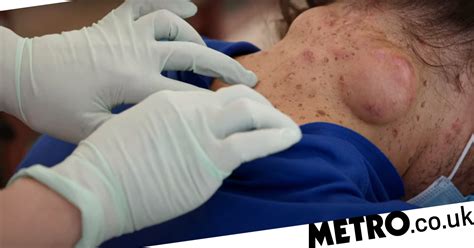 Dr Pimple Popper Called In To Help Man With Huge Cysts On