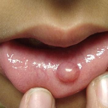 Try these home remedies for herpes mouth. painless bump on lip - pictures, photos