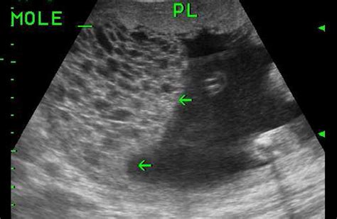 Ultrasound Scan At 20 Weeks Of Gestation Showing A Live Fetus And One