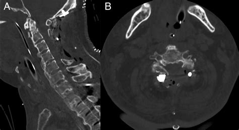 Temporary Vertebral Artery Occlusion After C3 Fracture Dislocation