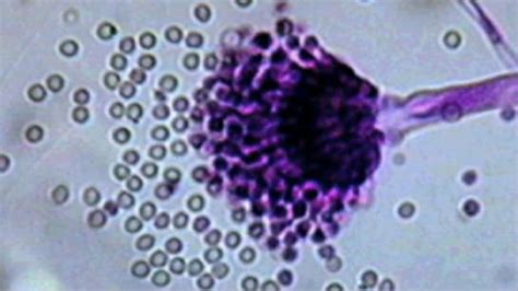 Cdc 7 Dead In Outbreak Of Rare Fungal Meningitis In Us Fox News Video
