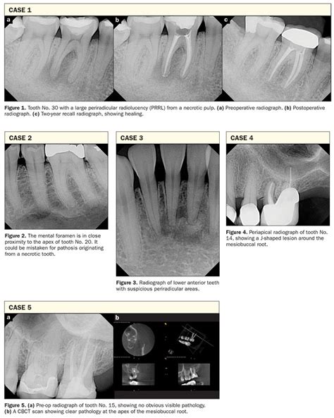 Apical Lesions Diagnostic Considerations Dentistry Today