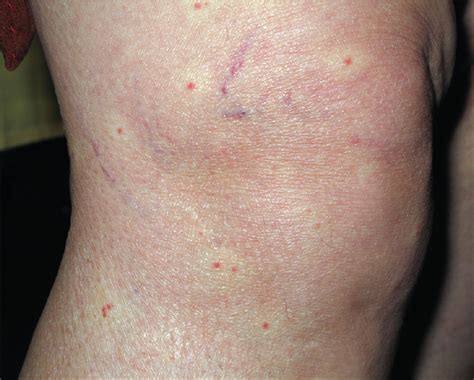 Asymptomatic Angiomatous Lesions On The Face And Limbs Of An Adult