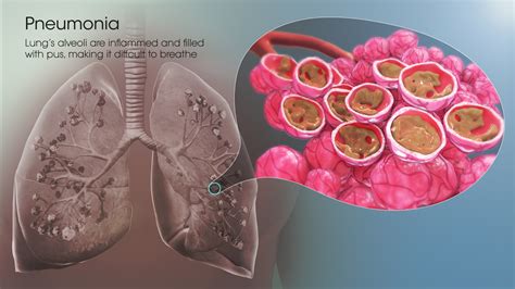 Mrsa As A Cause Of Lung Infection Including Airway