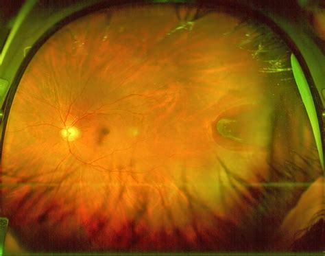Exudative detachment, in which the neurosensory retina is lifted away from the retinal pigment. All things eye | Por Yong Ming: Floaters, flashes of light ...