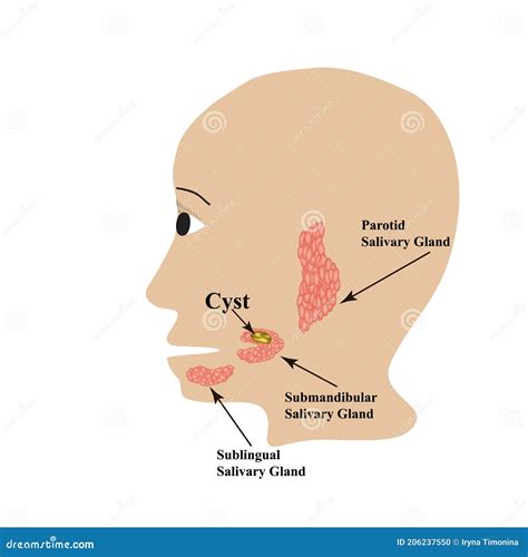 A Tumor On The Parotid Salivary Gland. Cartoon Vector | CartoonDealer
