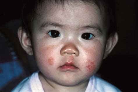Atopic Dermatitis Picture Image On