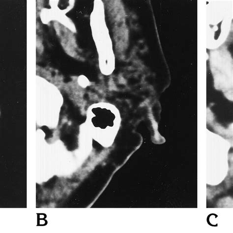 Ct Appearance Of Parotid Glands In Healthy Subject A And In Patients
