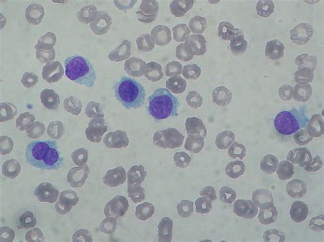 Hairy Cell Leukemia Hcl Oncology Medbullets Step 23