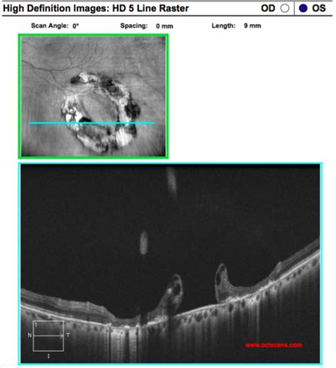 The retina, which is a neural layer which provides vision in the liquid that moves through this tear to back of retina starts to separate the retina from the eyewall. Retinal hole - Optical Coherence Tomography Scans