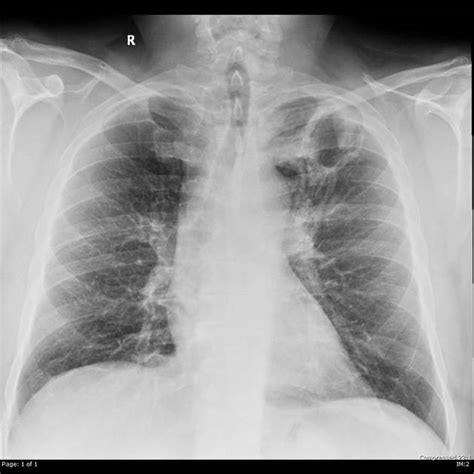 Pulmonary Metastases Radiology Reference Article