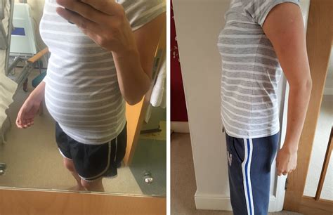 Woman Has Huge Ovarian Cyst Removed After Gym Instructor Asked If Shes